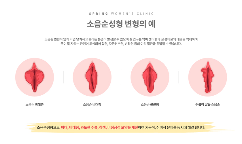 소음순 성형 설명 이미지