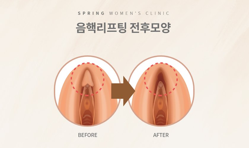 음핵 리프팅 설명 이미지