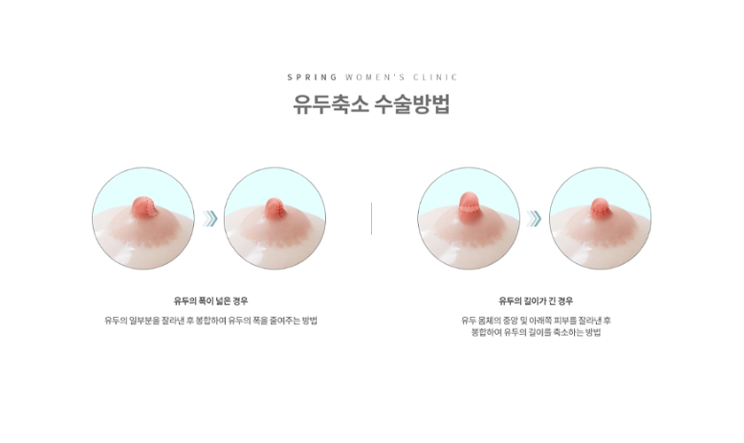 유두 축소술 설명 이미지